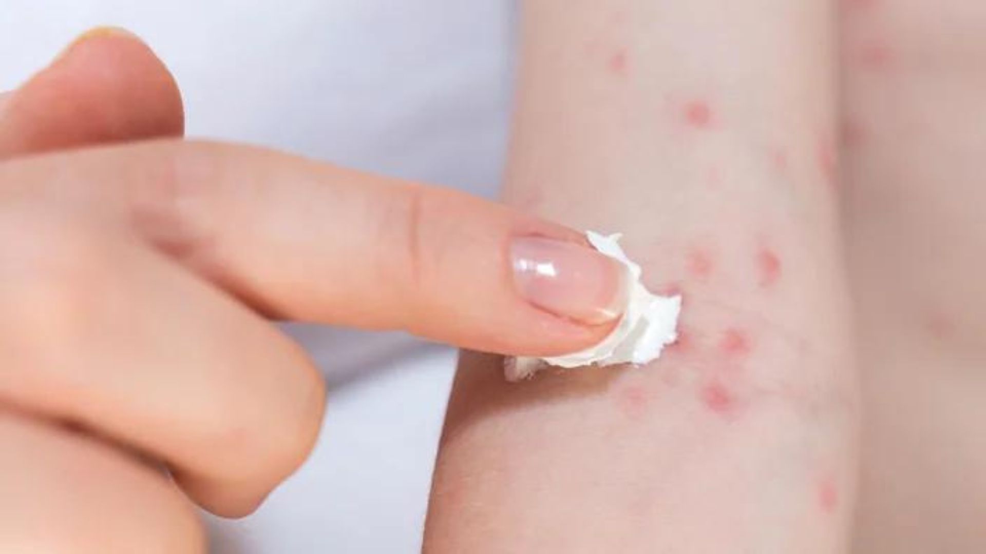 How to Treat Skin Allergies at Home: